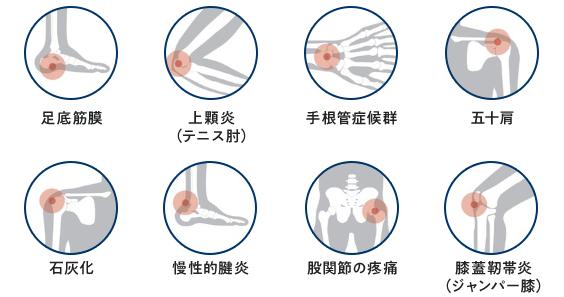 慢性腱障害