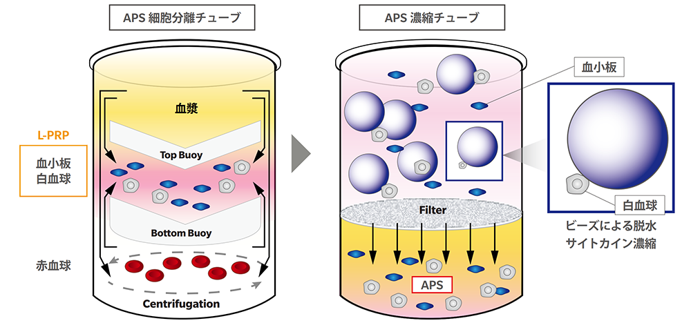 APS（次世代PRP)